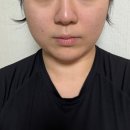 웨이브필 | 신사역 피부과 이중턱관리 엑셀웨이브 브이디파인 윤곽주사 후기