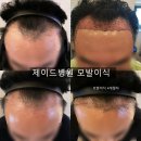 제이드의원 | 제이드 병원 모발이식 후기