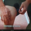 무릎뼈 연골 소실,자가늑연골세포 이식술 이미지