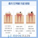 수성구 치과 충치가 많을 때 충치 단계별 맞춤 치료 후기