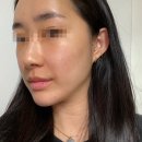 대전예쁨주의쁨의원 | (내돈내산) 대전 잡티제거 기미제거 예쁨주의쁨클리닉 레이저 후기 1회차