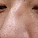 파티마성형외과 | 대구 코 골절 수술 후기-병원 찾기(성형외과는 불가능)