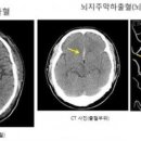 뇌동맥류 환자 급증...고혈압에 흡연은 가능성 높여 이미지