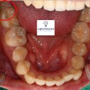 더굿치과의원 | 더굿모닝치과 광명사거리역점 수면사랑니발치 비용, 통증, 과정에 대한 안내(feat. 원장 직접)