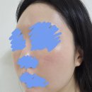 바른뜸한의원 | 주사피부 한의원 침치료 내원치료 후기/자윤수액2주 사용 후기