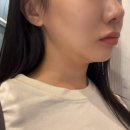 밥성형외과의원 | 리모성형외과에서 이중턱살제거+근육묶기+투턱없앤 후기(내돈내산)