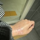 건강한뇌신경과의원 | 백반증 치료 후기｜미세표피이식SST 모내기법 + 엑시머레이저 받은 솔직 후기
