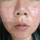 닥터지의원 | 닥터에버스의원 인천점 피부과 “피코프락셀” 1회...고민으로 시술 받은 후기 &amp; 이벤트가비용130,900원...