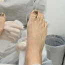 레푸스 구월점 내성발톱 무좀발톱 발각질 문제성발 이미지