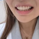 강남 무삭제라미네이트 : 세라네이트 최종 부착 후기