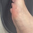 건대성모외과의원 | 건대성모외과의원 : 발에 점 제거, 조직검사 후기