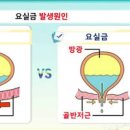 요실금 원인 치료 종류 요실금에 좋은 음식 이미지