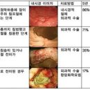 위암 초기 전조 3기 4기 위암에 좋은 음식 이미지