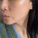 고고한의원 | 강남 큐어람 한의원 얼굴 편평사마귀 제거 꼼꼼한 원장쌤 후기