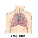 비호지킨 림프종[Non-Hodgkin lymphoma]종양혈액질환 이미지