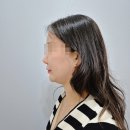 화이트성형외과의원 | [ㄹㅁ성형외과 내돈내산] 이중턱살제거+근육묶기+투턱없애기 후기 (수술 1개월차 변화 대공개!)