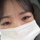 샤이멍 | *대구 성형외과 꼬막눈 앞트임, 듀얼트임(뒷트임 + 밑트임)* 2~5일차 붓기 애교살 후기