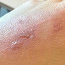 화도약국 | 나트랑 마사지 주의! 인생 마사지인 줄 알았는데 세균감염...