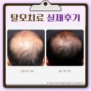 계수내과의원 | 시흥탈모병원｜M자·정수리 고민으로 상담에서 가장 많이 나오는 질문