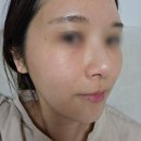 진피앤피 | 남양주 평내호평 피부과 ECM 스킨부스터 셀르디엠 비포에프터 후기