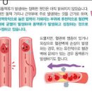 별다른 이 없는 뇌동맥류의 위협 지주막하출혈 위험성과 예방방법 이미지