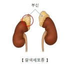 부신갈색세포종 이미지