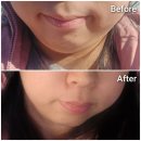 (주)수원 보장구 수리센터 | 수원 온다리프팅 이중턱 고민 덜어내고 예비신부 턱선 정돈하기