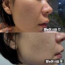 일주일 | 야당역 피부과 볼뉴머600샷 고주파 리프팅 일주일 후기