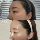 이마 | 수원 인계동 이마필러 후기 | 시술 전후