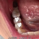 더와이즈치과병원 | [더와이즈치과 임플란트] 완료!! 7개월간의 대장정의 끝* 해외거주자에게 추천!