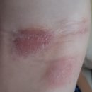 이봉구피부과의원 | 아토피 피부염 좋아진 후기 공유 (뉴스킨, 건강식단, 피부과)