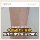 두형제홈케어 | 수족구 초기증상부터 등원까지｜첫째·둘째 동시 수족구 후기, 고열·수액 치료·보험청구까지