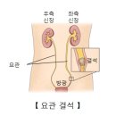 요로 결석(尿路結石, kidney stone) 이미지