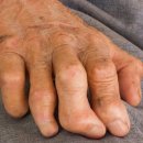Leprosy: Ancient disease able to regenerate organs 이미지