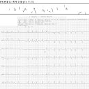 명치 끝이 답답하고 어지러움을 호소하는 심방세동 환자 치험례. 기사 2025.10.20. 이미지