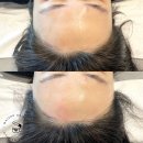 썬헤어라인 이미지