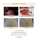 급성담낭염수술후기. 심한 복통과 우상복부의 통증이 매우 심하여 한국을 찾아 튼튼병원 단일공복강경센터를 방문하게 되었습니다. 이미지