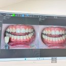 현치과의원 | 본식 전 강남레브치과 원데이치아미백 내돈내산후기