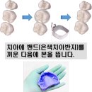 파란치과기공소 | 악궁확장장치 치료 전 과정(파란 고무링, 돌리기, 제거)