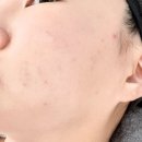 모드 - 전주시 완산구 문학로 9 | bbl 레이저 후기 모드 주기 원리 가격 : 압구정로데오역 피부과 내돈내산
