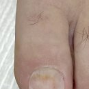 클린풋 | [대구] 무좀발톱 내성발톱 관리 솔직후기 : 클린풋앤네일