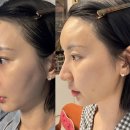 더블유피부과의원 | 더블유클리닉 삼성점에서 스컬트라 받고온 후기