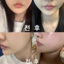 별고운빛의원 | 슈링크 리프팅 잘하는곳 추천! 남양주 별내 피부과 슈링크 300샷 후기