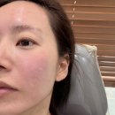 사항 | 사당 피부과 리투오 효과, 주의사항, 부작용 후기