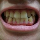 클릭 매니아 덴탈 | *치아미백제* 셀프치아미백 효과가 뛰어난 웰포유 좀비치아미백으로 황니탈출!!