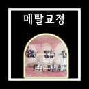 브레이스치과의원 | 남양주교정치과 메탈교정장치, 여전히 건재한 이유는?