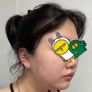 베리굿성형외과 모든 시수술 할인 및 방문 전 모든 꿀팁 (전/후 사진, 주의사항, 주차정보 포함)