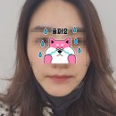 (주)봄날소프트 | 청담피부과 소프웨이브 통증 효과 후기