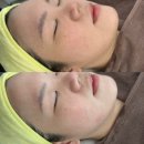 그린에너지플라자 | 수원피부관리 더끌올팅 리프팅관리 후기 늘그린스킨