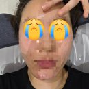 JY피부과의원 | [압구정역 피부과]리쥬란힐러 2cc 10만원대 맞고왔어요! (feat.제네시스토닝)